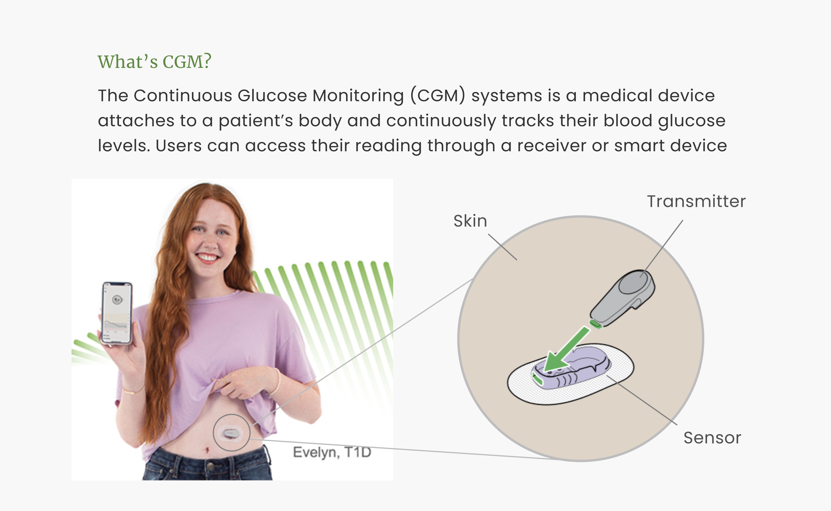 CGM